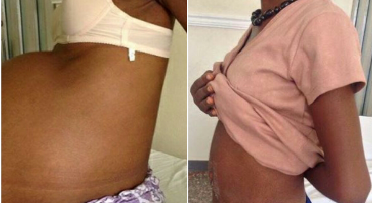 FIBROID BEFORE AND AFTER