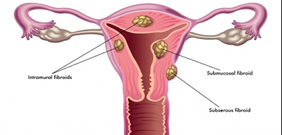 UTHERINE FIBROID